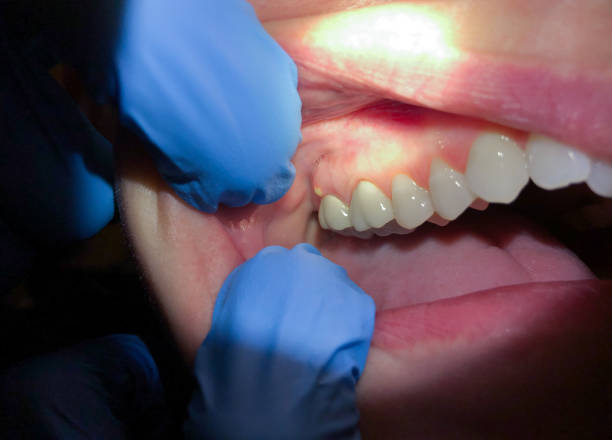 Best Emergency Denture Repair in Bradley, WV