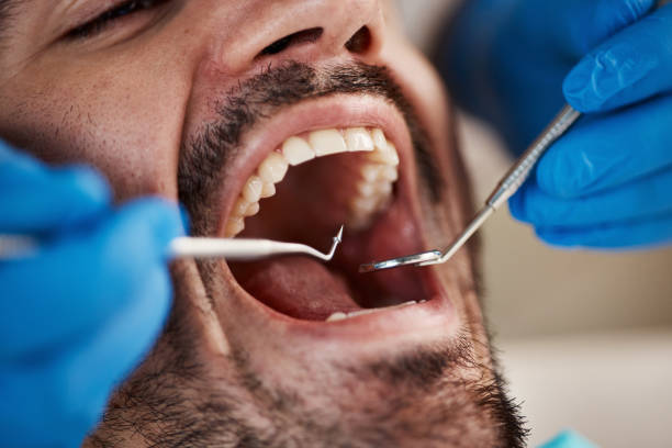 Best Emergency Wisdom Teeth Removal in Bradley, WV